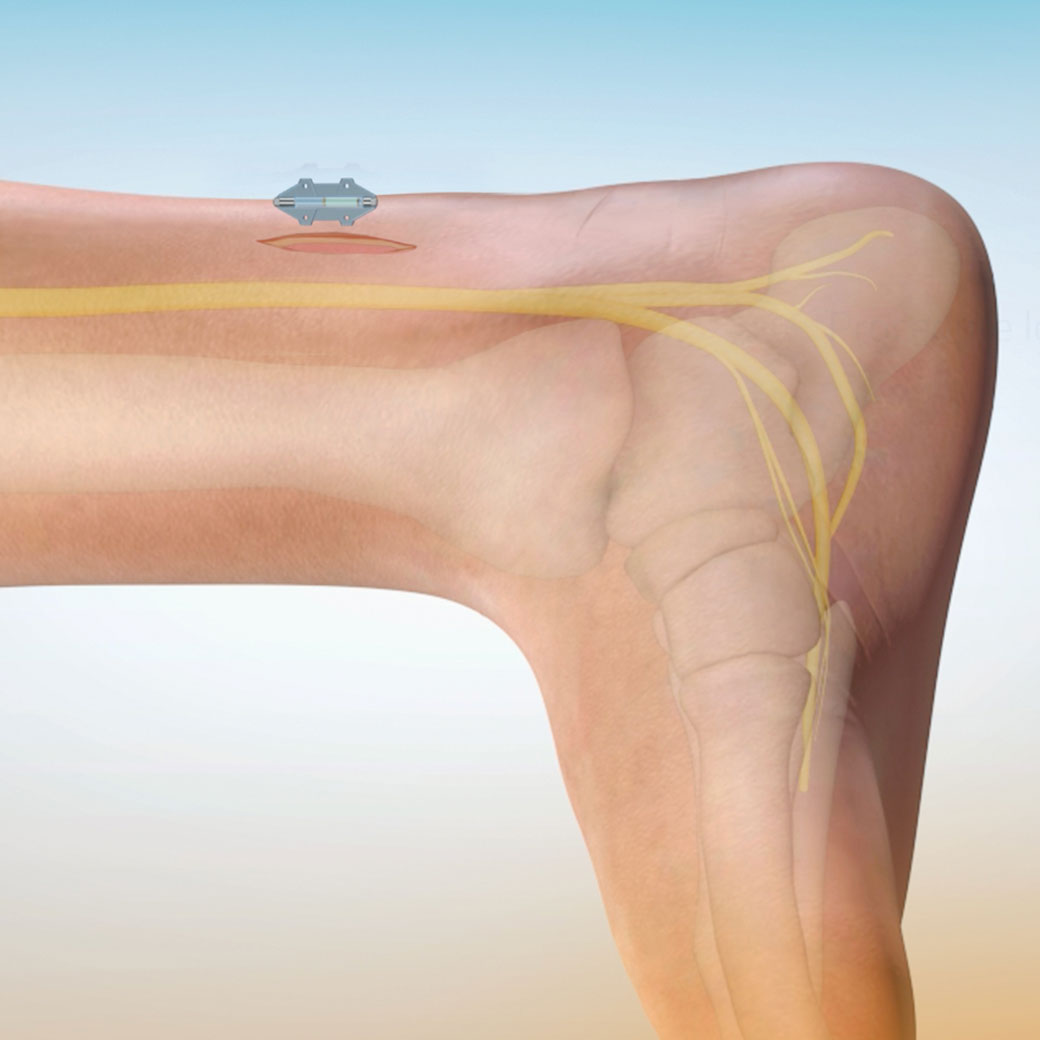 Illustration displaying the placement of the implant on the tibial nerve near the ankle.